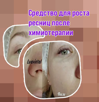 Средство для роста ресниц после химиотерапии